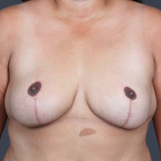 Implant Removal Before & After Gallery - Patient 148982 - Image 2