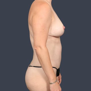 Mommy Makeover Before & After Gallery - Patient 711458 - Image 6