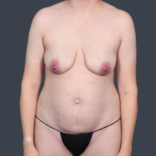 Before procedure image for Mommy Makeover