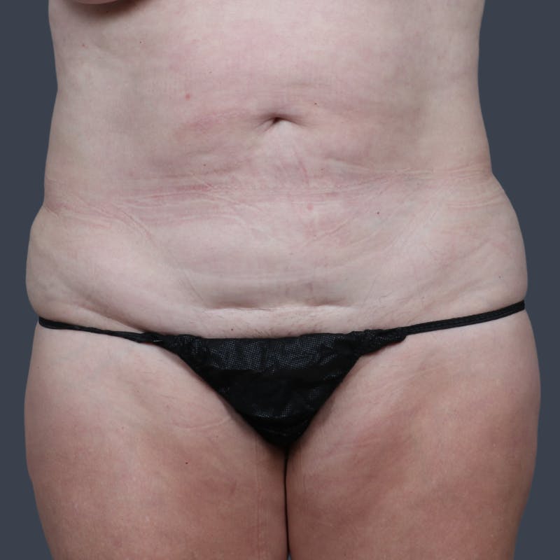 Abdominoplasty / Tummy Tuck Before & After Gallery - Patient 280872 - Image 1