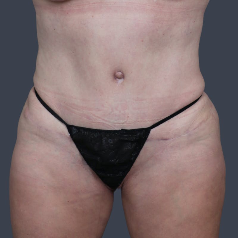 Abdominoplasty / Tummy Tuck Before & After Gallery - Patient 280872 - Image 2