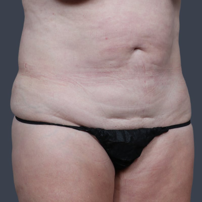 Abdominoplasty / Tummy Tuck Before & After Gallery - Patient 280872 - Image 3