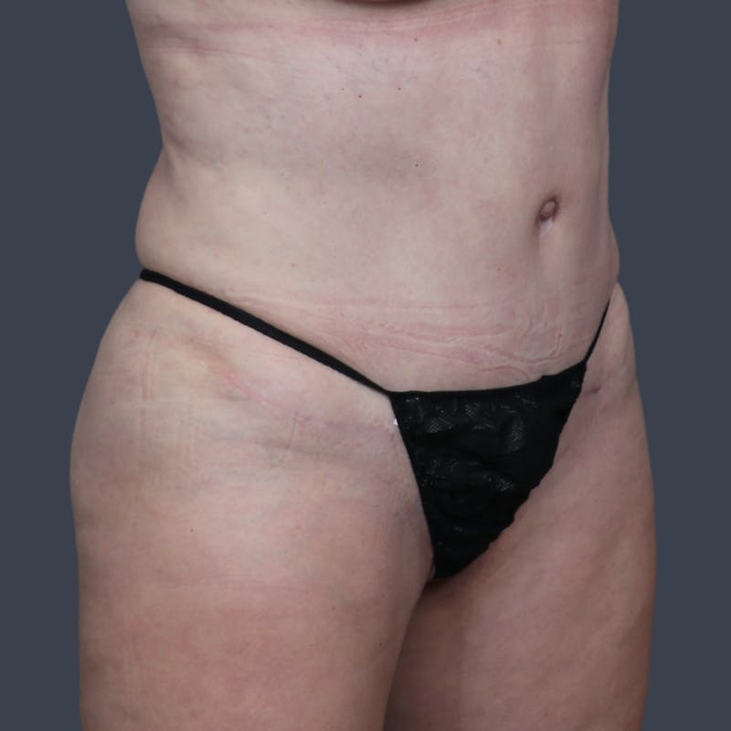 Abdominoplasty / Tummy Tuck Before & After Gallery - Patient 280872 - Image 4