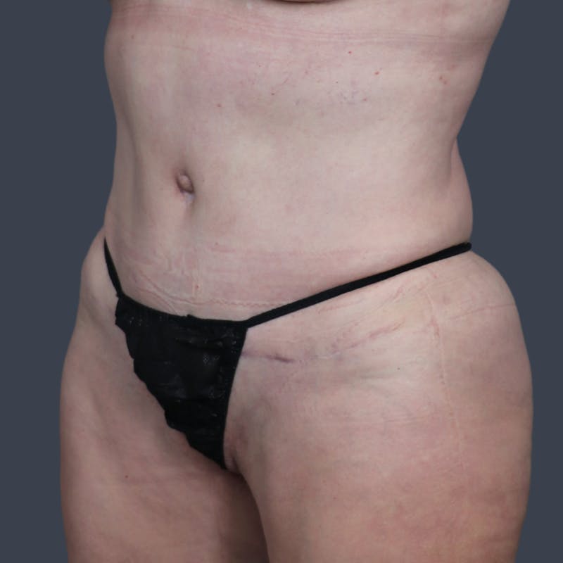 Abdominoplasty / Tummy Tuck Before & After Gallery - Patient 280872 - Image 6