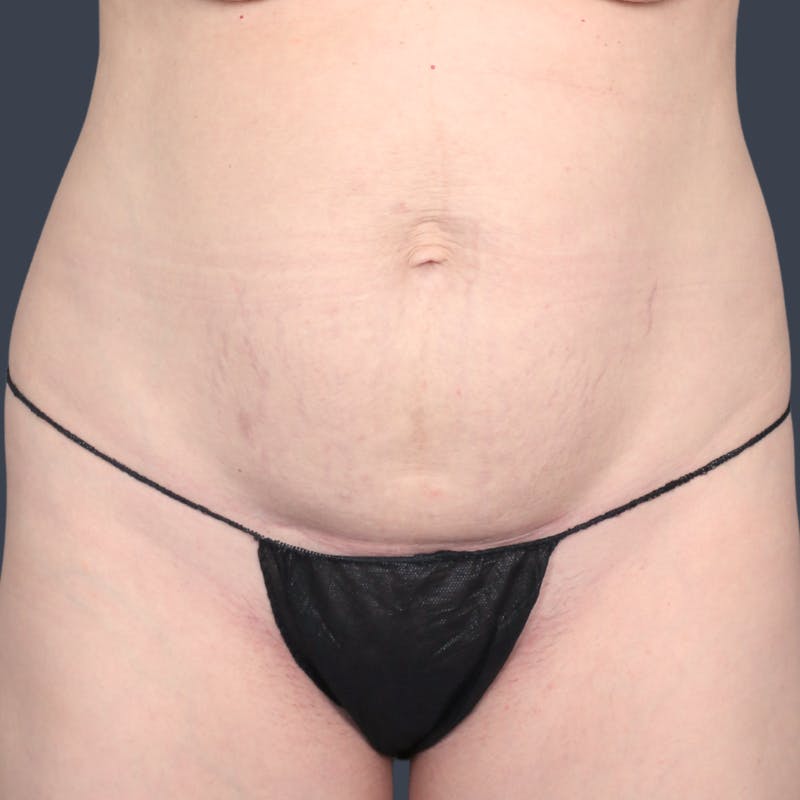 Abdominoplasty / Tummy Tuck Before & After Gallery - Patient 360398 - Image 1