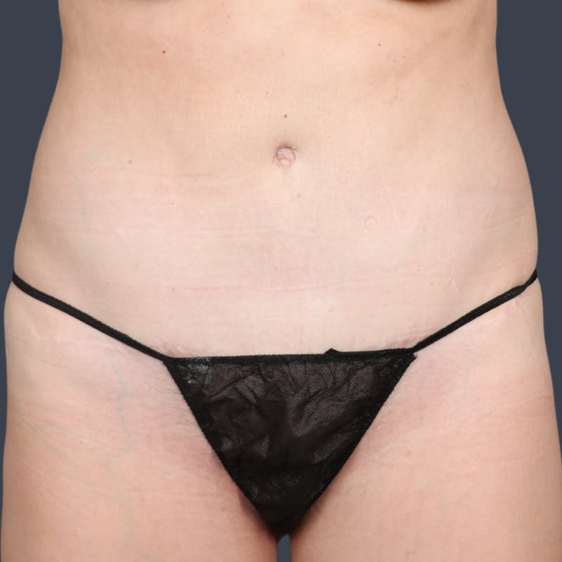 Abdominoplasty / Tummy Tuck Before & After Gallery - Patient 360398 - Image 2