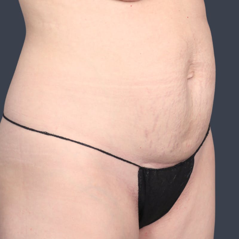 Abdominoplasty / Tummy Tuck Before & After Gallery - Patient 360398 - Image 3