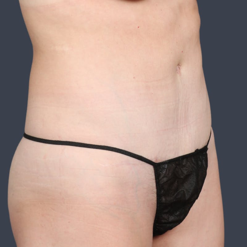 Abdominoplasty / Tummy Tuck Before & After Gallery - Patient 360398 - Image 4