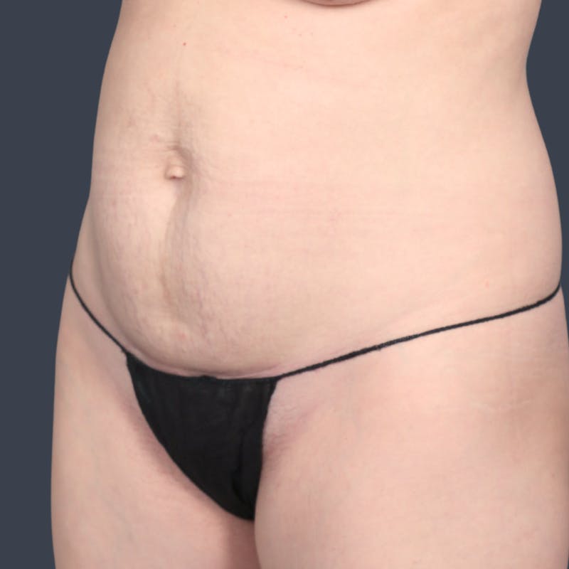 Abdominoplasty / Tummy Tuck Before & After Gallery - Patient 360398 - Image 5