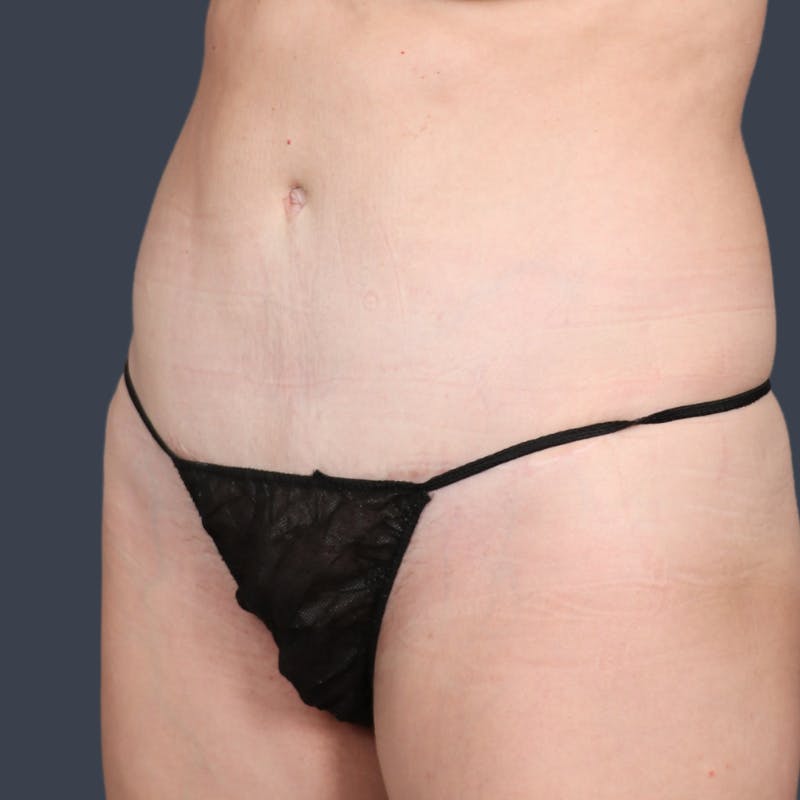 Abdominoplasty / Tummy Tuck Before & After Gallery - Patient 360398 - Image 6