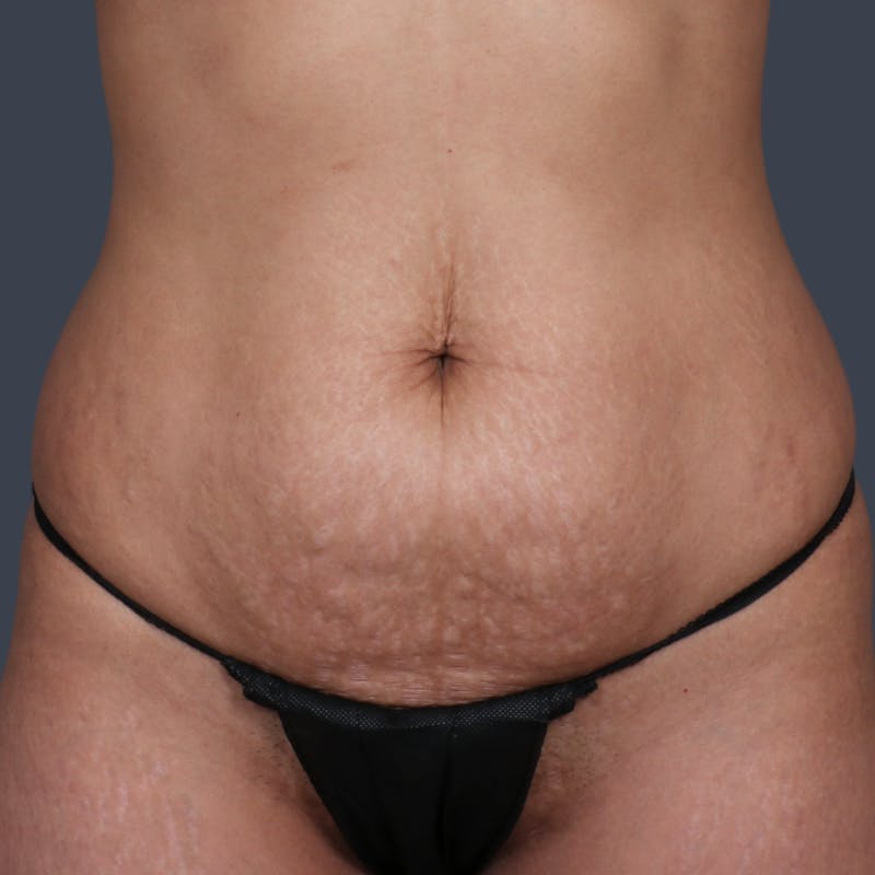 Abdominoplasty / Tummy Tuck Before & After Gallery - Patient 327190 - Image 1