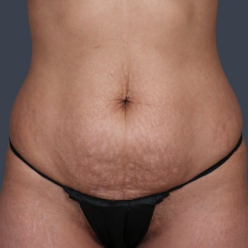 Before procedure image for Abdominoplasty / Tummy Tuck