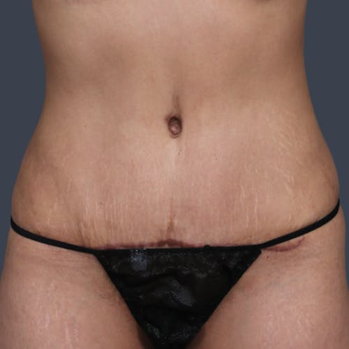 After procedure image for Abdominoplasty / Tummy Tuck