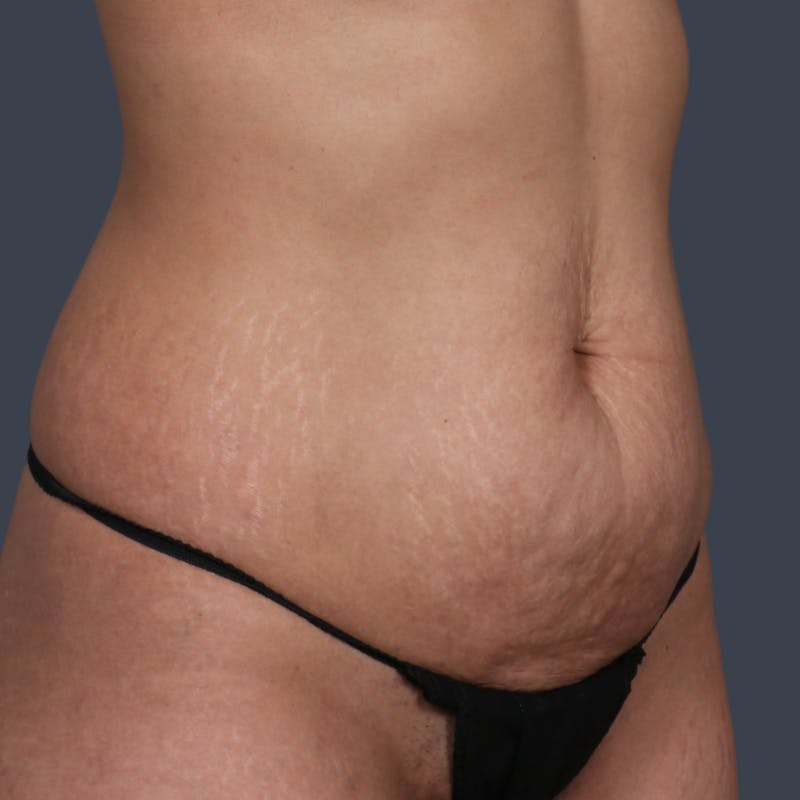 Abdominoplasty / Tummy Tuck Before & After Gallery - Patient 327190 - Image 3
