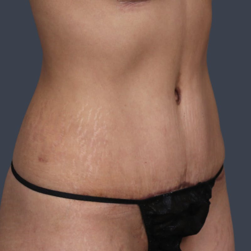 Abdominoplasty / Tummy Tuck Before & After Gallery - Patient 327190 - Image 4