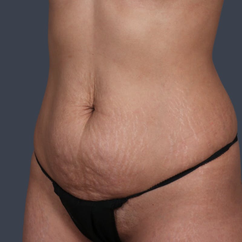 Abdominoplasty / Tummy Tuck Before & After Gallery - Patient 327190 - Image 5