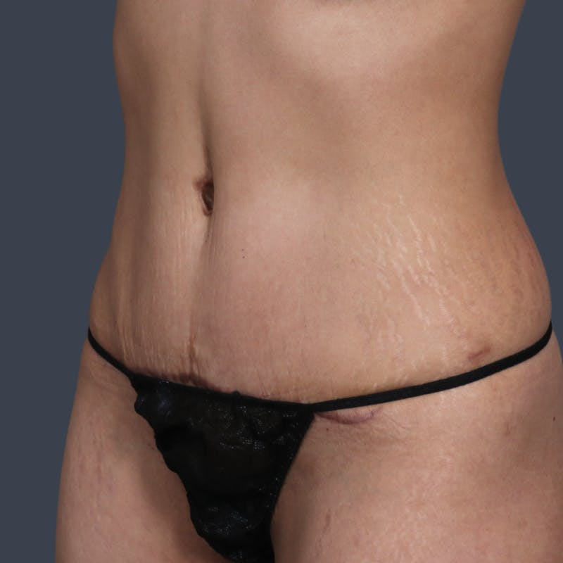 Abdominoplasty / Tummy Tuck Before & After Gallery - Patient 327190 - Image 6