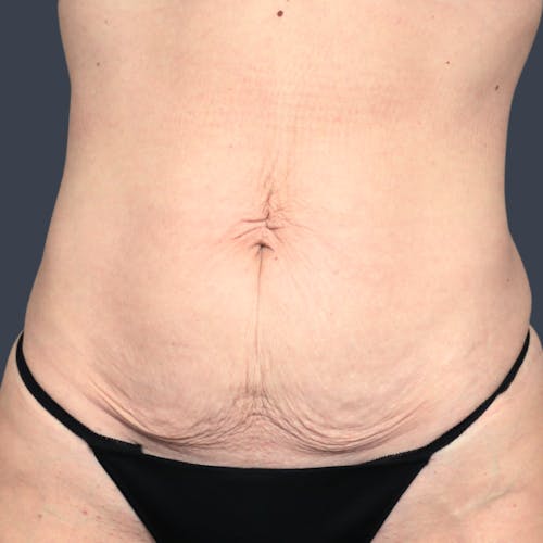 Before procedure image for Abdominoplasty / Tummy Tuck