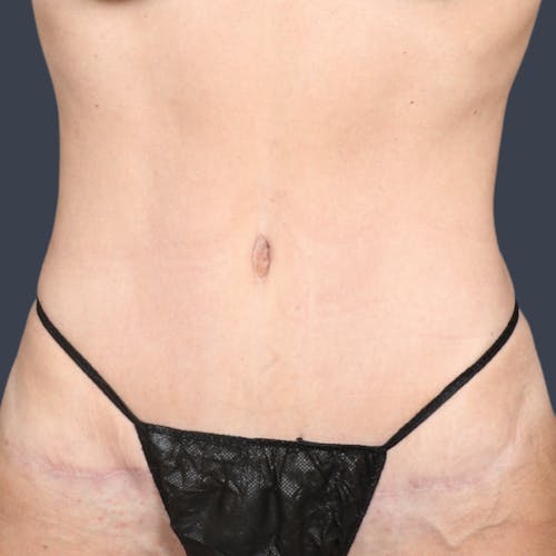 After procedure image for Abdominoplasty / Tummy Tuck