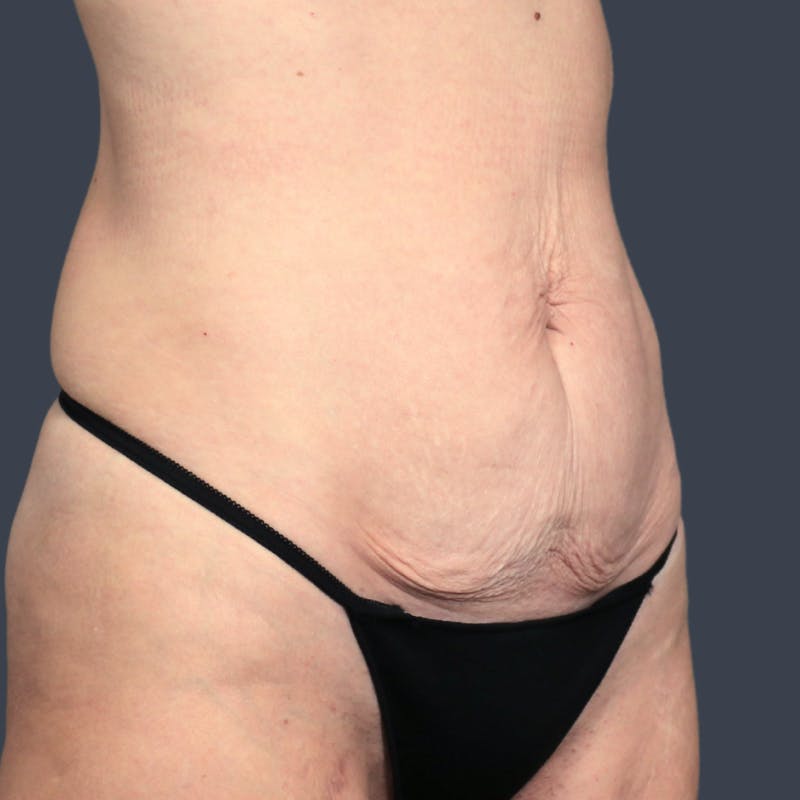 Abdominoplasty / Tummy Tuck Before & After Gallery - Patient 193960 - Image 3