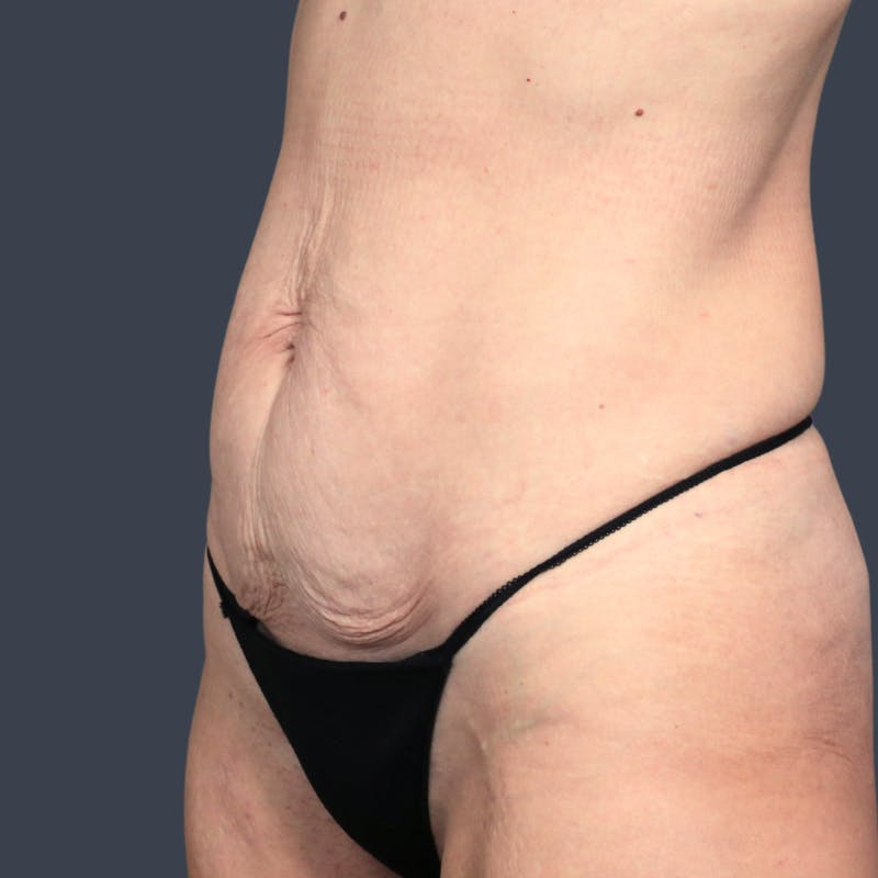 Abdominoplasty / Tummy Tuck Before & After Gallery - Patient 193960 - Image 5