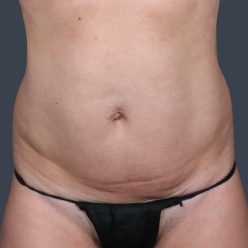 Before procedure image for Abdominoplasty / Tummy Tuck