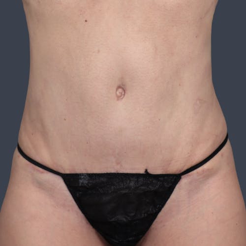 After procedure image for Abdominoplasty / Tummy Tuck