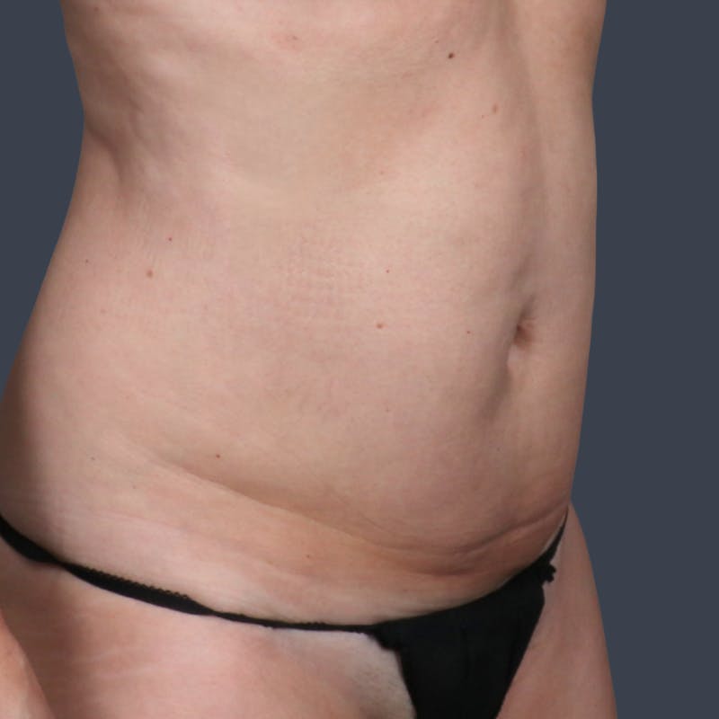 Abdominoplasty / Tummy Tuck Before & After Gallery - Patient 168275 - Image 3
