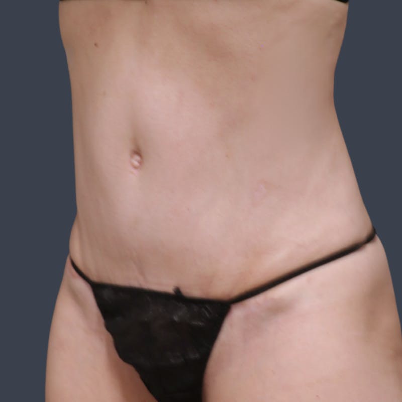 Abdominoplasty / Tummy Tuck Before & After Gallery - Patient 168275 - Image 6