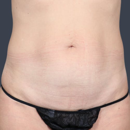 Before procedure image for Abdominoplasty / Tummy Tuck
