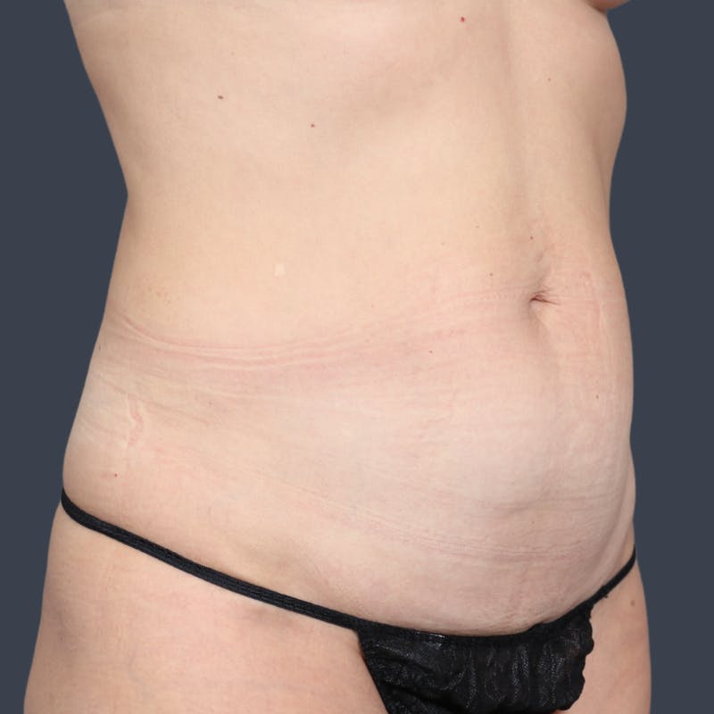 Abdominoplasty / Tummy Tuck Before & After Gallery - Patient 184391 - Image 3