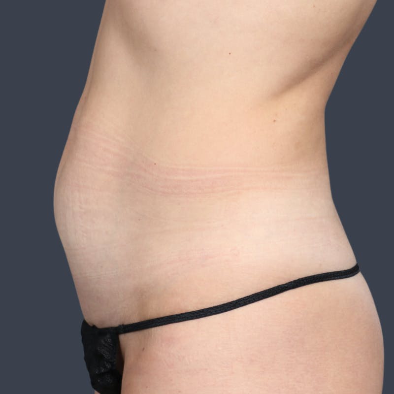 Abdominoplasty / Tummy Tuck Before & After Gallery - Patient 184391 - Image 5