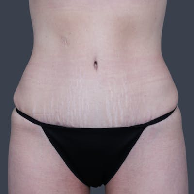 Abdominoplasty / Tummy Tuck Before & After Gallery - Patient 374596 - Image 2