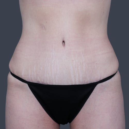After procedure image for Abdominoplasty / Tummy Tuck