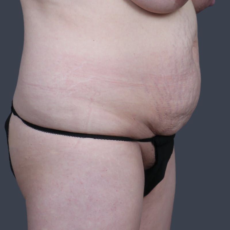 Abdominoplasty / Tummy Tuck Before & After Gallery - Patient 374596 - Image 3