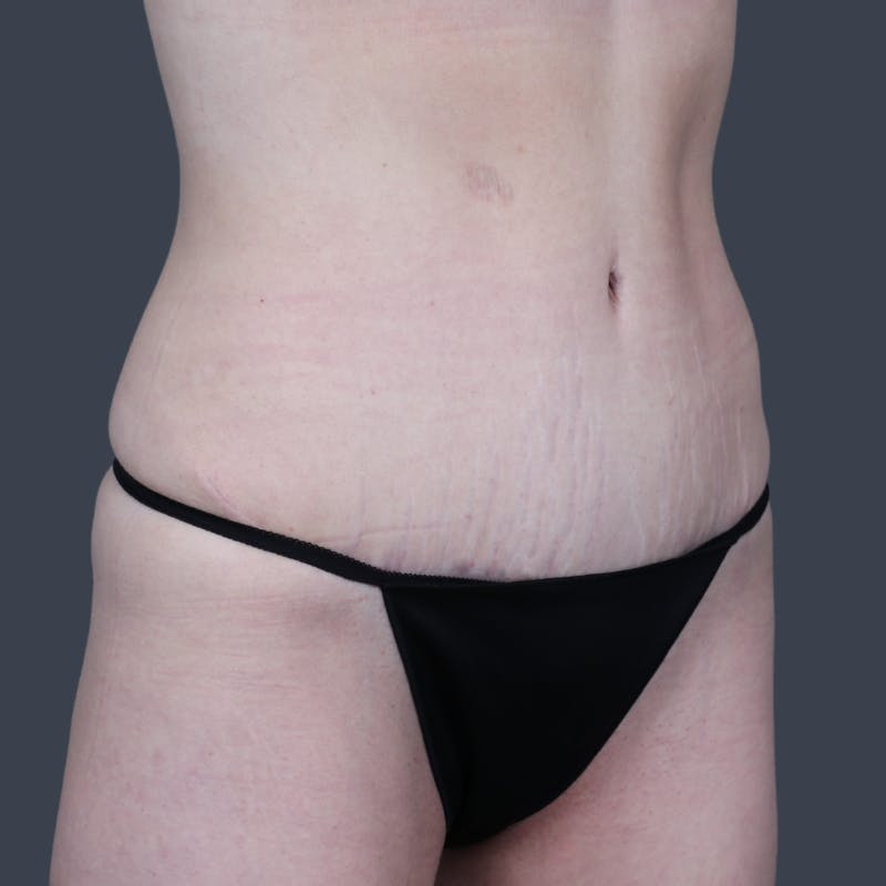 Abdominoplasty / Tummy Tuck Before & After Gallery - Patient 374596 - Image 4