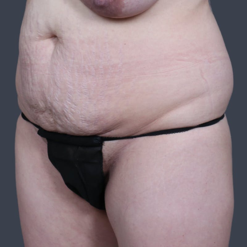 Abdominoplasty / Tummy Tuck Before & After Gallery - Patient 374596 - Image 5