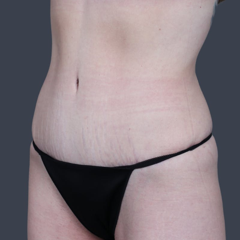 Abdominoplasty / Tummy Tuck Before & After Gallery - Patient 374596 - Image 6