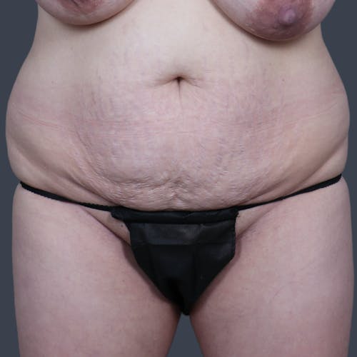 Before procedure image for Abdominoplasty / Tummy Tuck