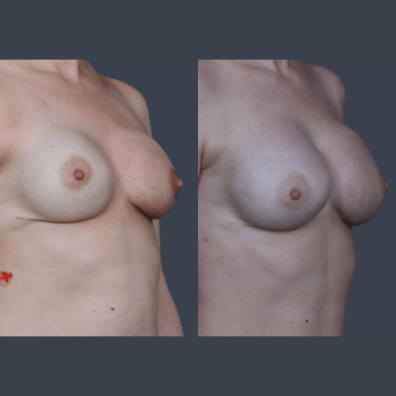Implant Breast Reconstruction Before & After Gallery - Patient 429071 - Image 4