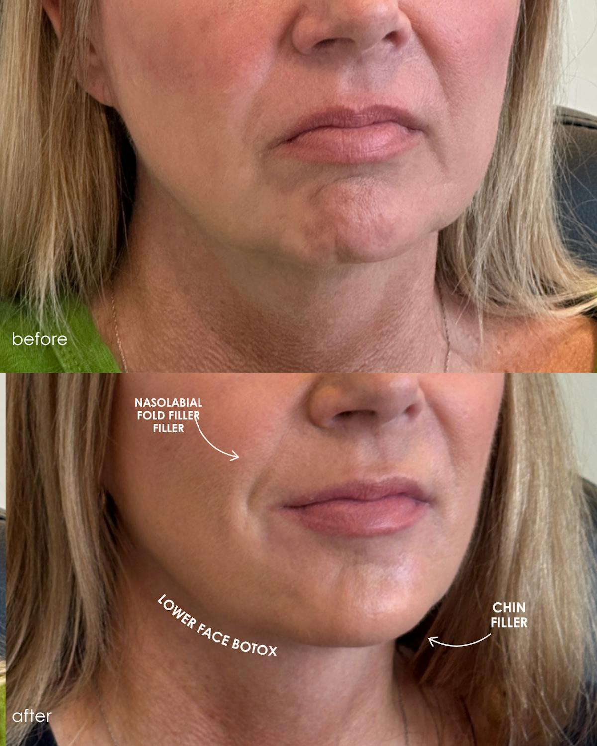 Facial Balancing Before & After Gallery - Patient 161667 - Image 2