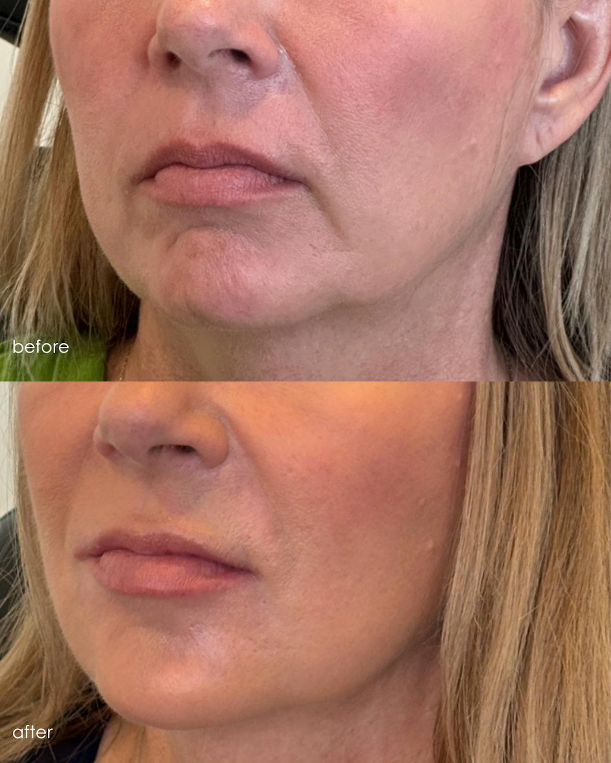 Facial Balancing Before & After Gallery - Patient 161667 - Image 1