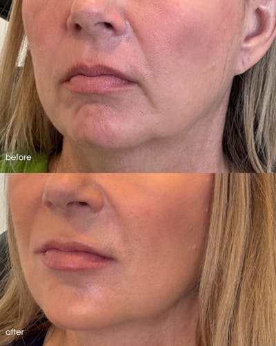 Facial Balancing Before & After Gallery - Patient 161667 - Image 1