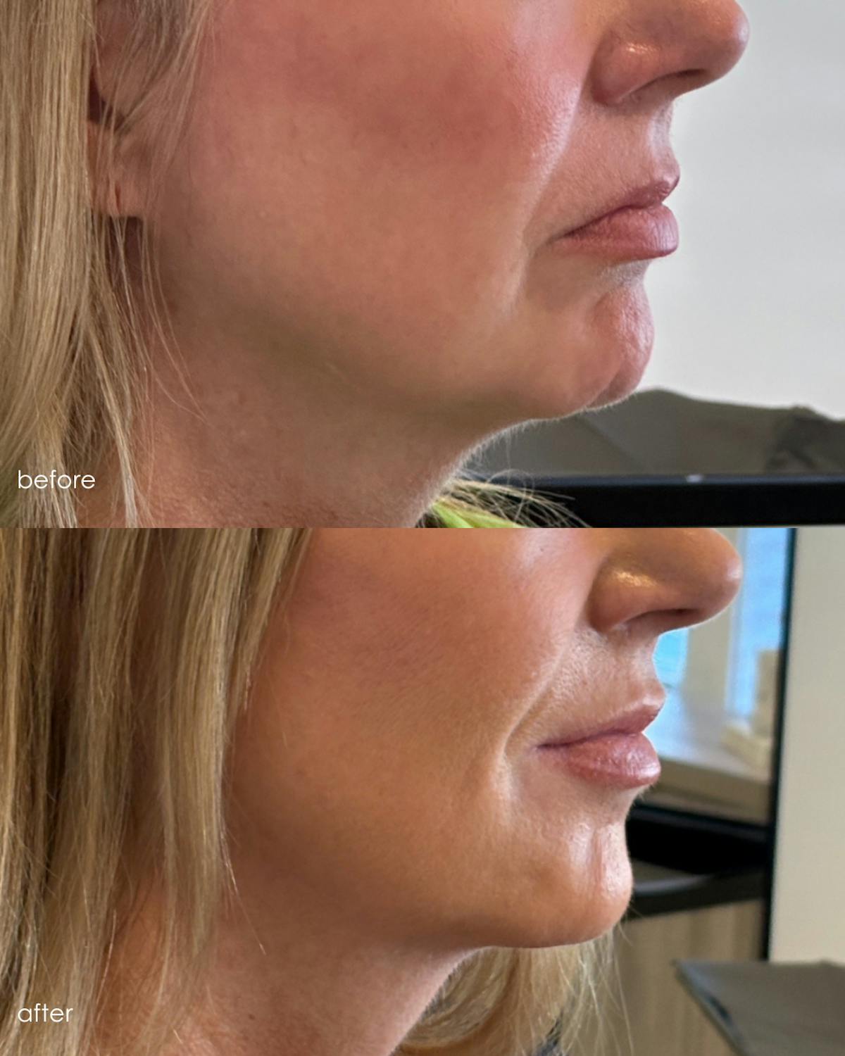 Facial Balancing Before & After Gallery - Patient 161667 - Image 3