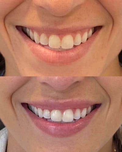 Lip Filler Before & After Gallery - Patient 363122 - Image 1