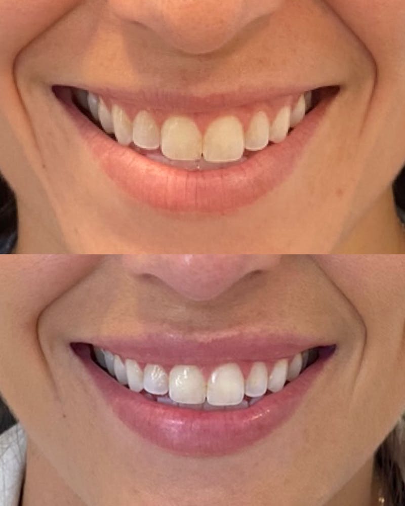 Lip Filler Before & After Gallery - Patient 363122 - Image 1