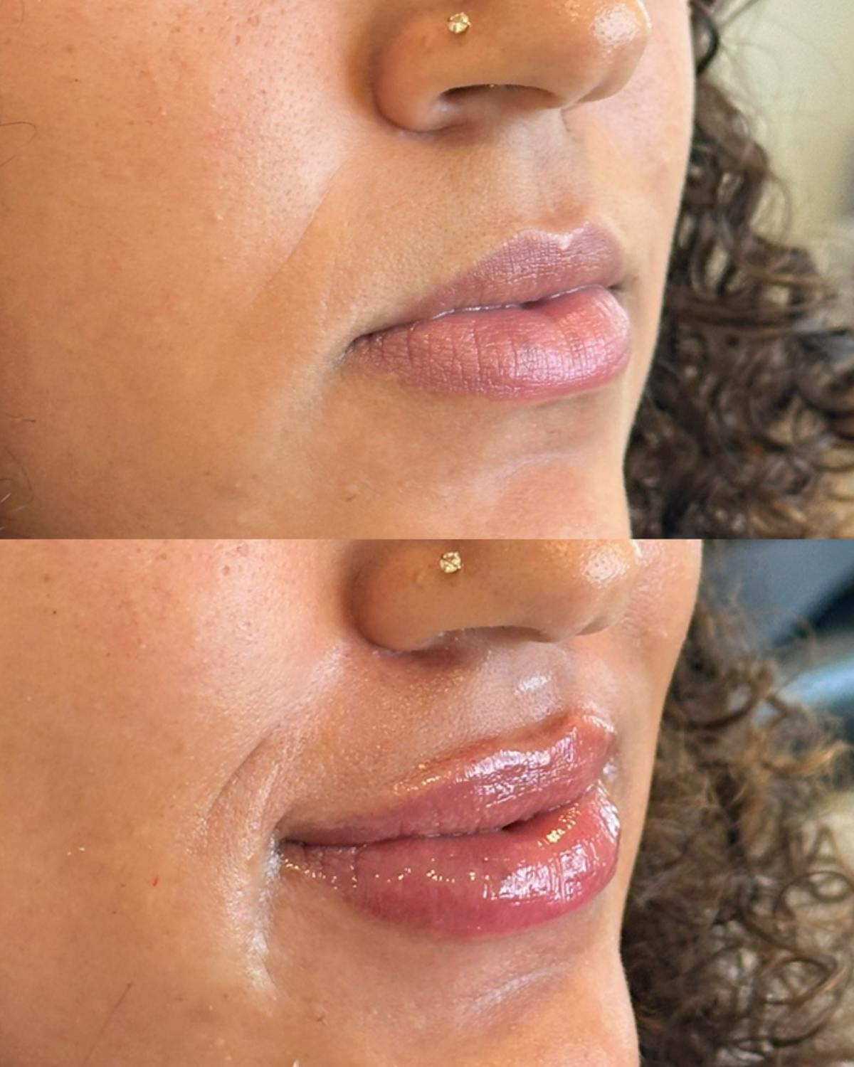 Lip Filler Before & After Gallery - Patient 234834 - Image 1