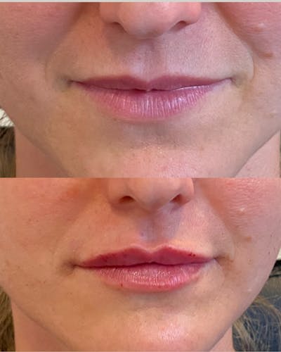 Lip Filler Before & After Gallery - Patient 232125 - Image 1