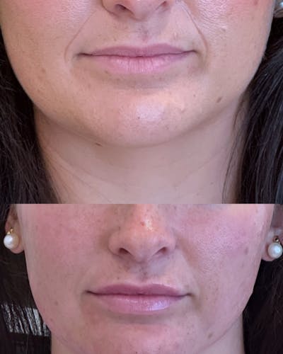 Lip Filler Before & After Gallery - Patient 190164 - Image 1
