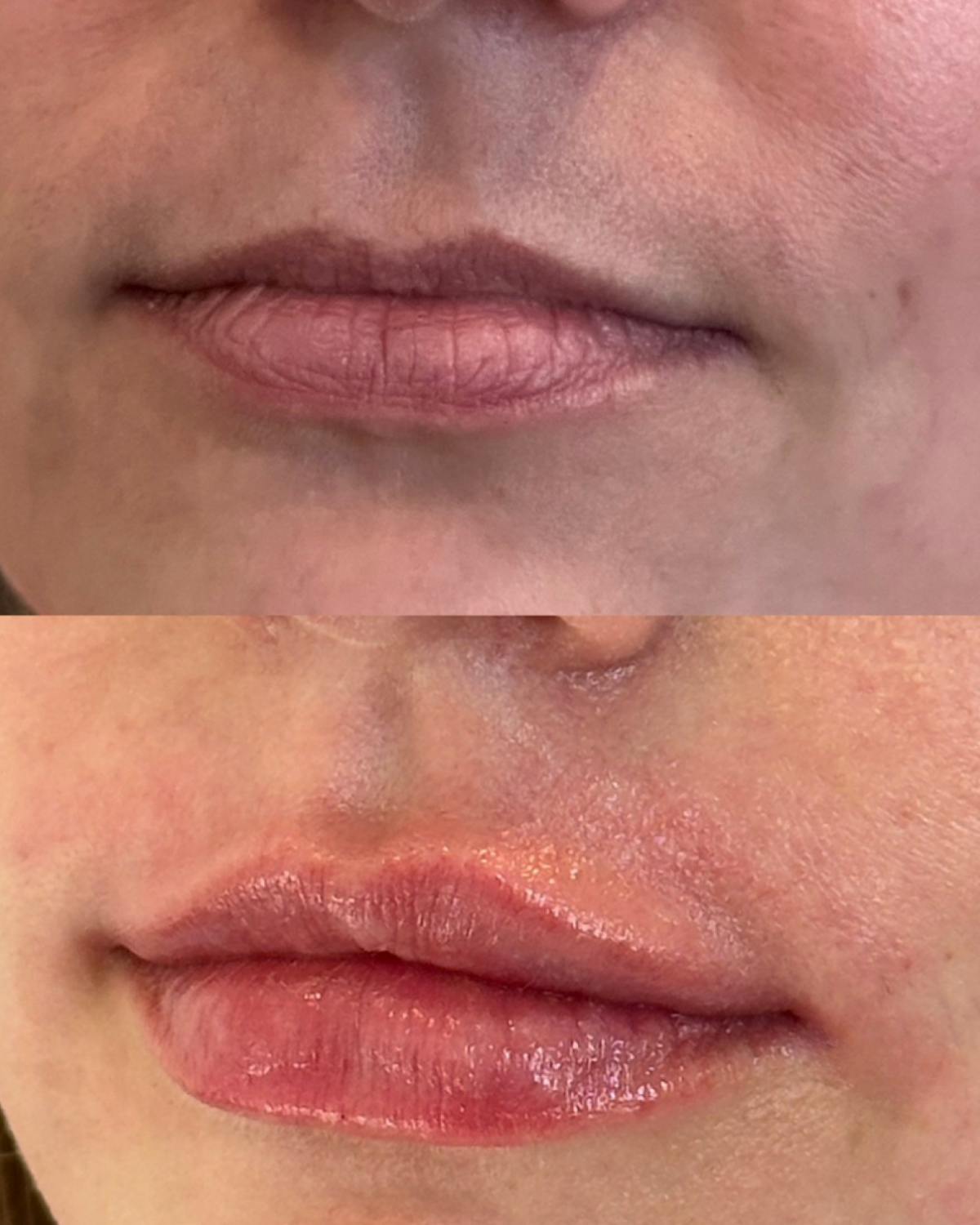 Lip Filler Before & After Gallery - Patient 195521 - Image 1